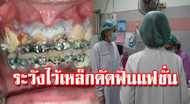 ดัดฟัน